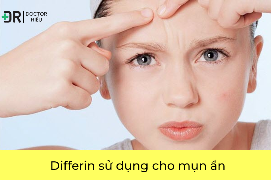 Differin dành cho mụn ẩn