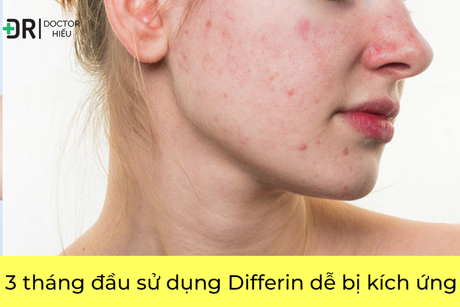 Differin dễ bị kích ứng trong 3 tháng đầu